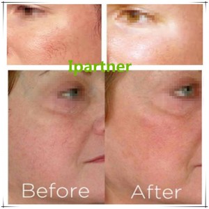 Ipartner LS980 다이오드 레이저 발산 시스템 완화