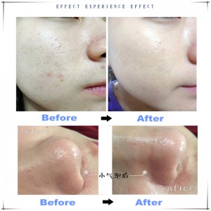 Ipartner 수소 산소 작은 거품 hydrofacial 6 1 다기능 피부 청소기