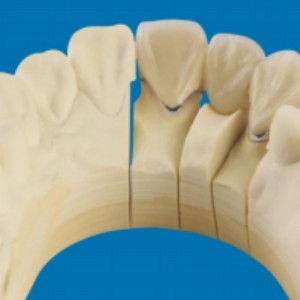 금속-도자기 치아