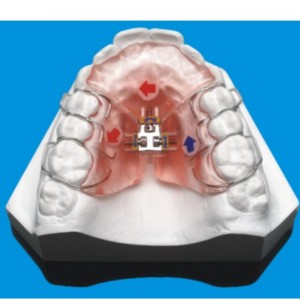 치열 교정 시리즈